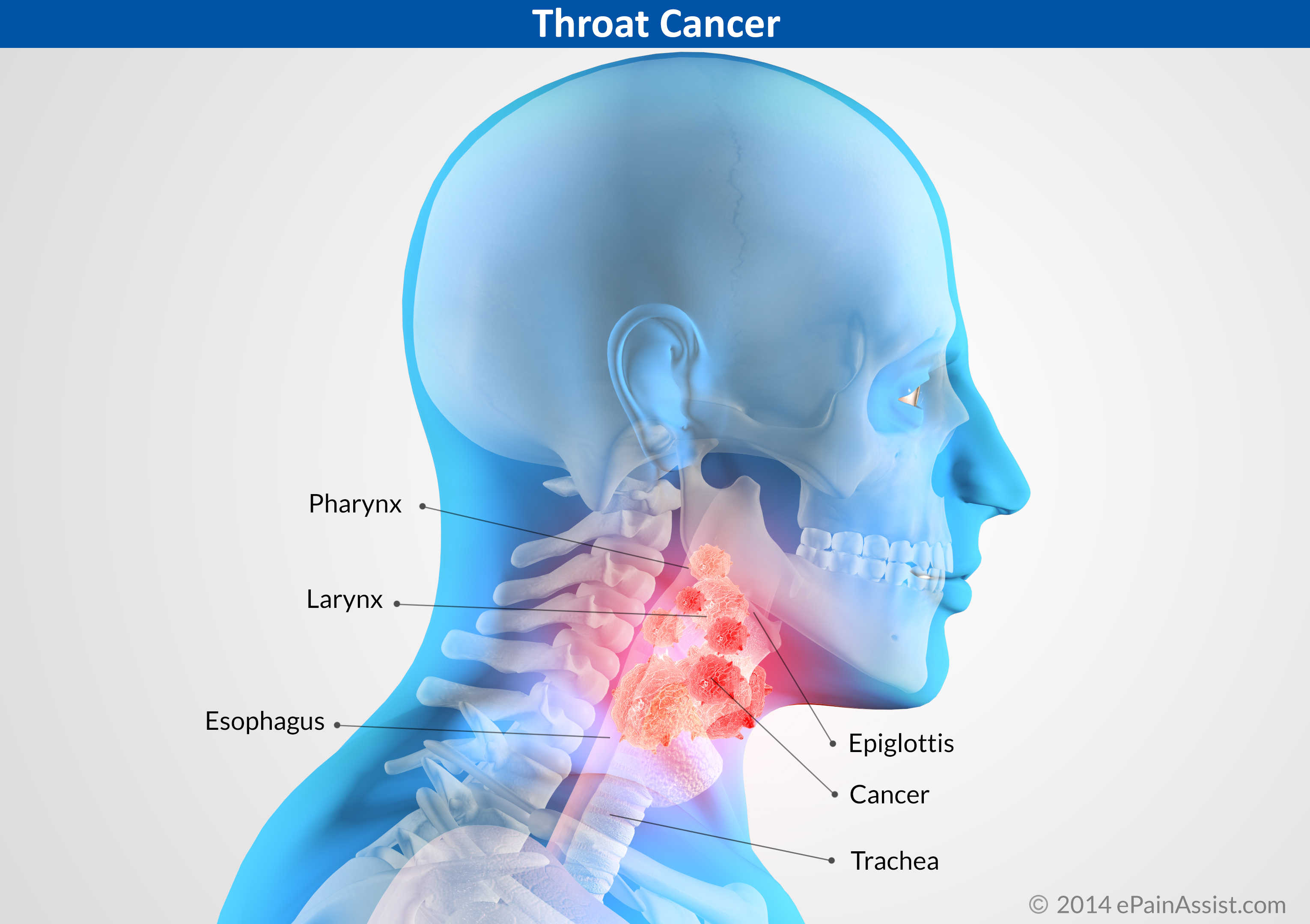 Cancerele de cap și gât.  Tutunul și alcoolul, principalii factori de risc