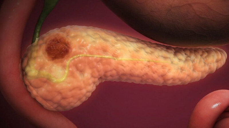 Testele care ar putea ajuta la depistarea precoce a cancerului pancreatic