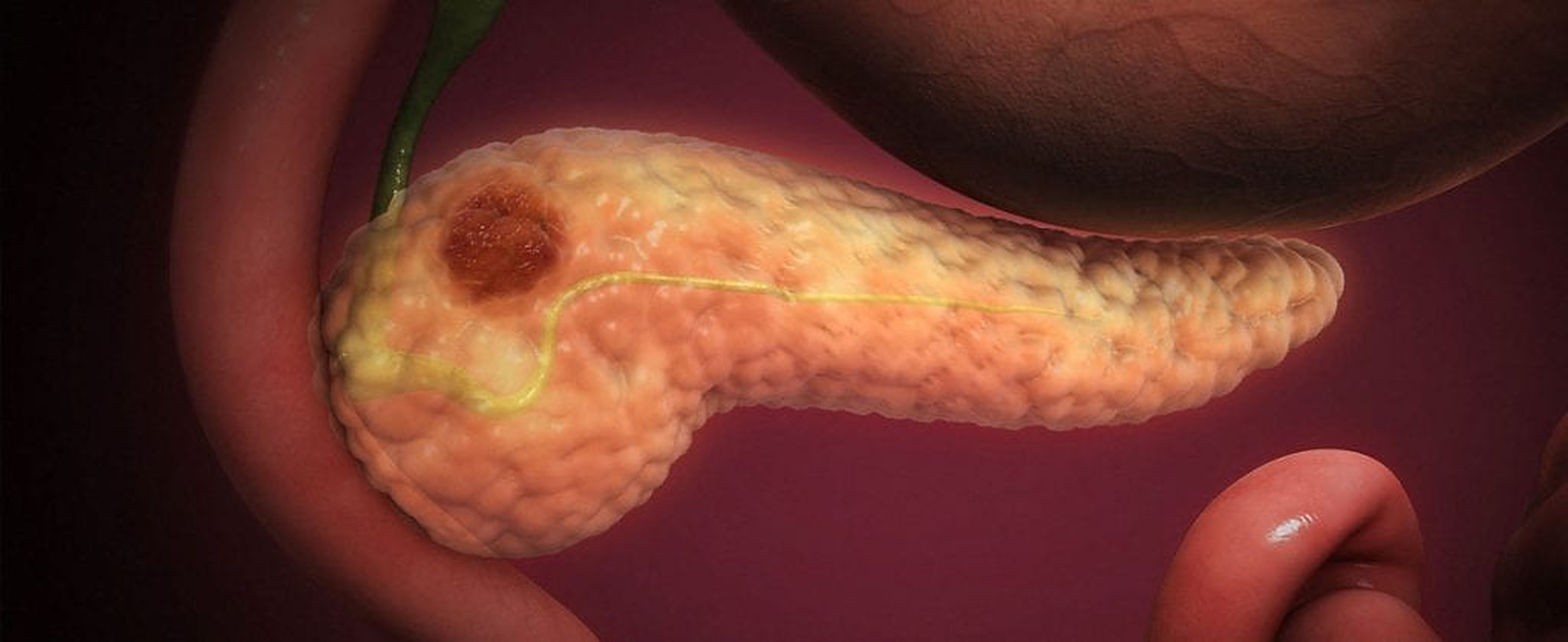 Testele care ar putea ajuta la depistarea precoce a cancerului pancreatic