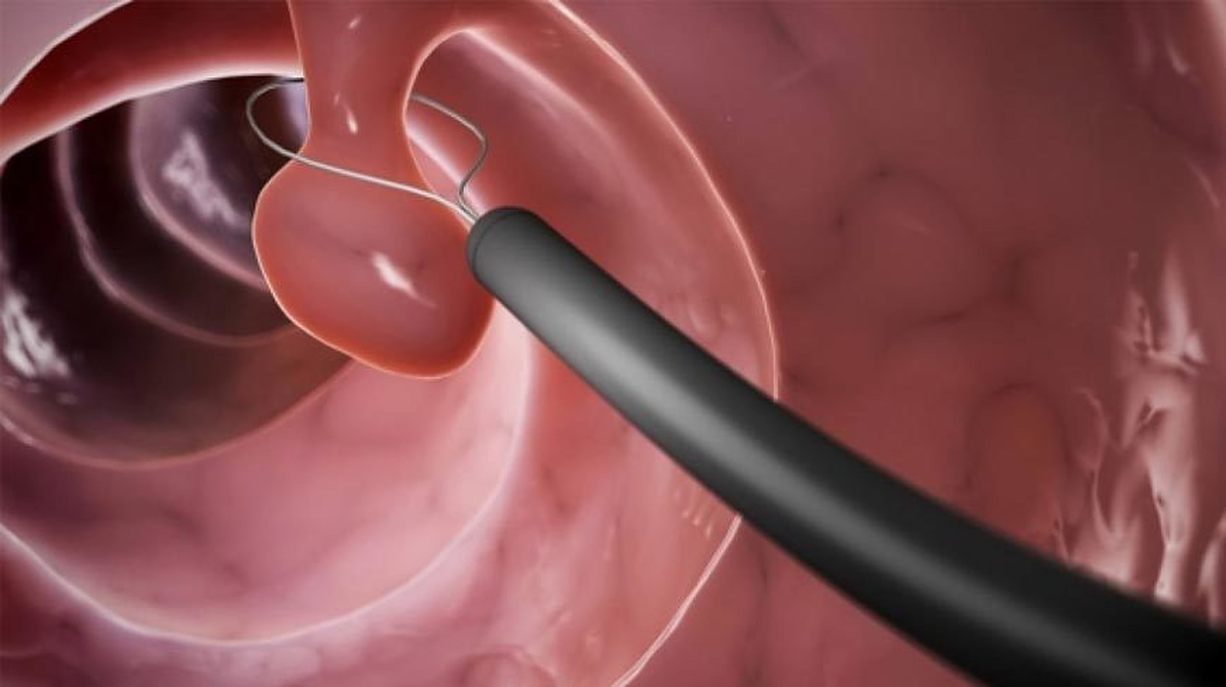 Dr. Victor Stefănescu, medic primar chirurgie generală: O simplă colonoscopie vă poate salva viaţa!