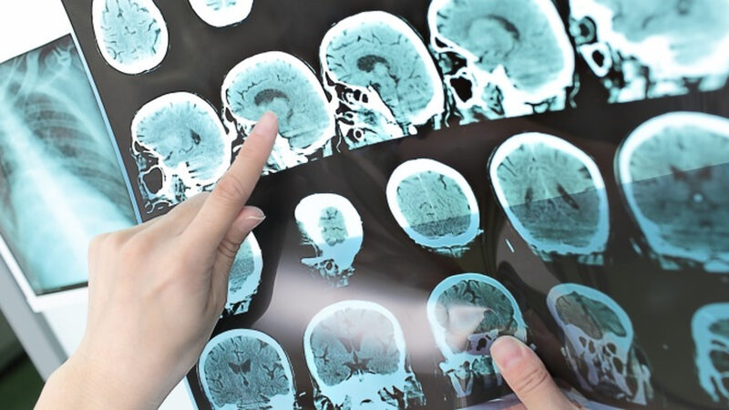 Pacienții cu traumatisme cranio – cerebrale vor fi introduși în PRESENT, primul registru internațional dedicat patologiei traumatice