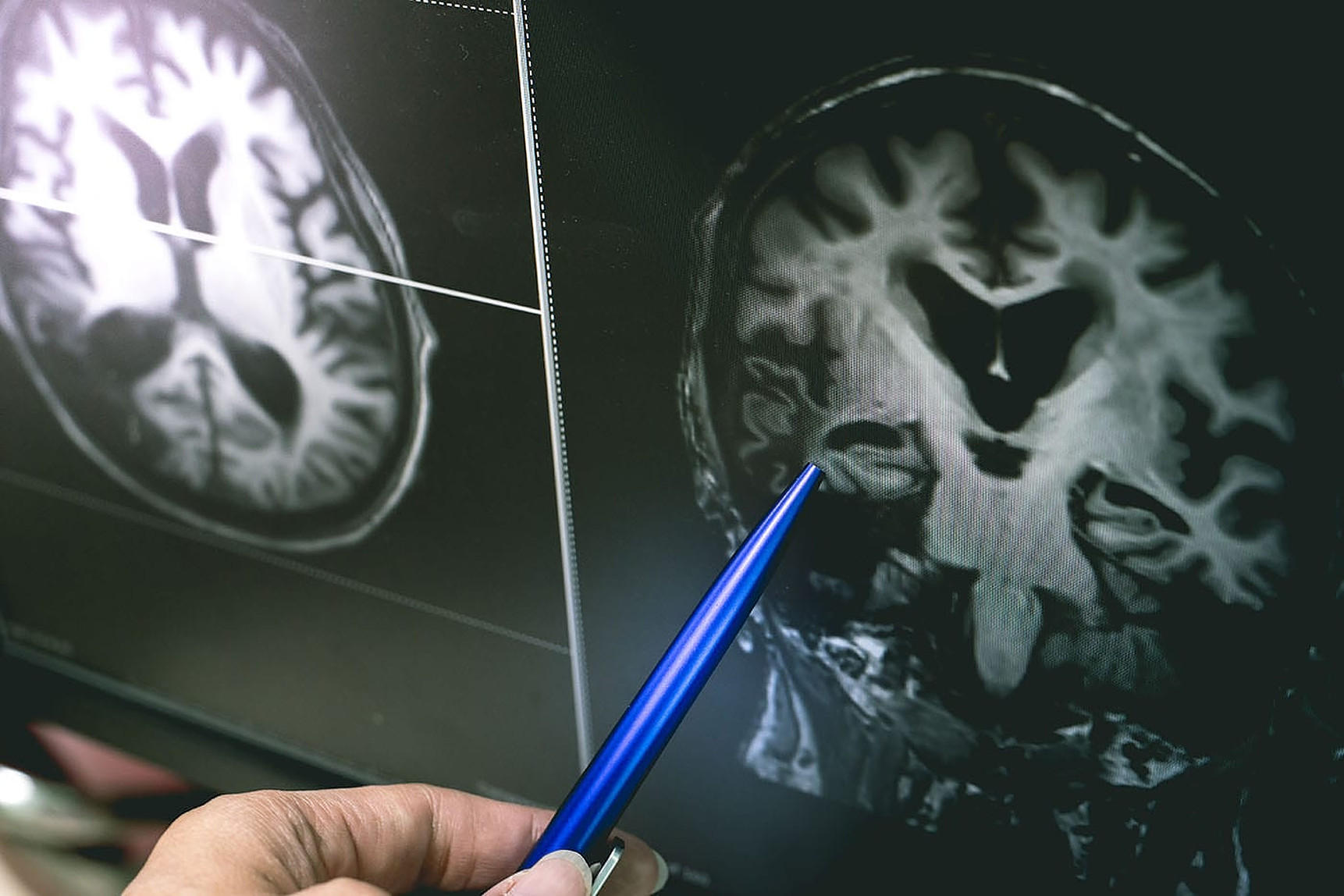 Poate o singură scanare a creierului să diagnosticheze cu exactitate boala Alzheimer? Studiu