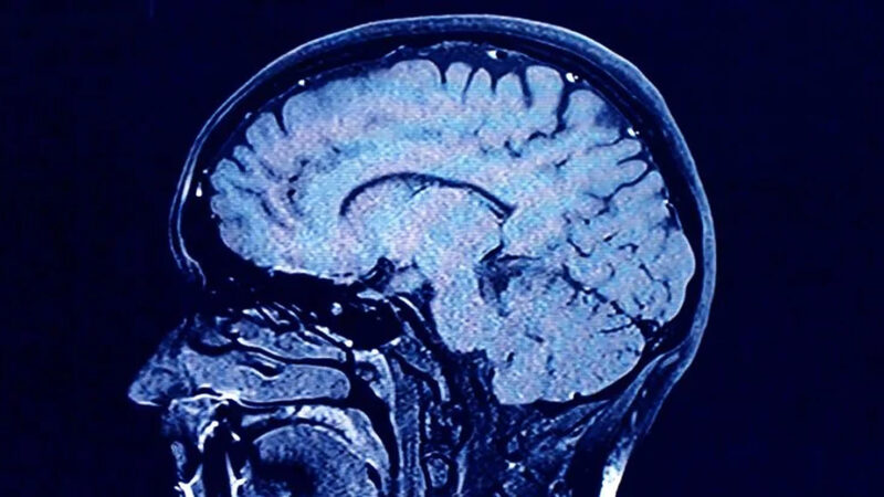 Anorexia poate duce la schimbări dramatice în structura creierului. Studiu