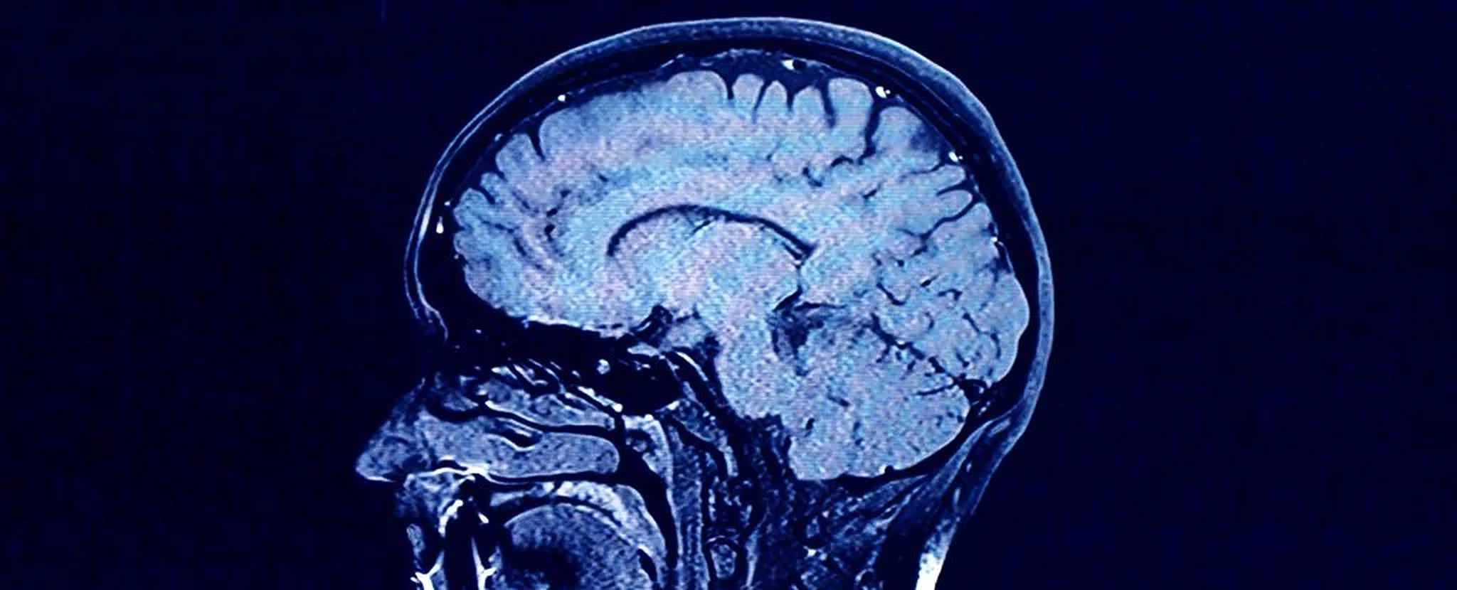 Anorexia poate duce la schimbări dramatice în structura creierului. Studiu