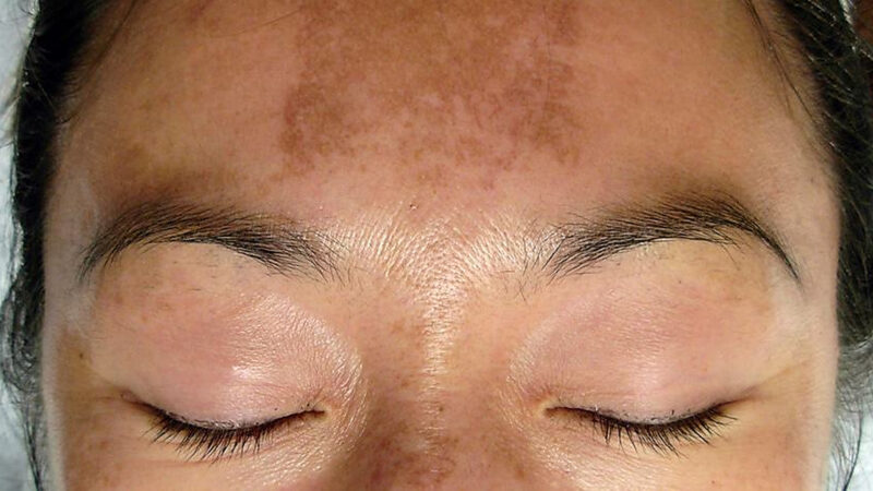 Ce trebuie să știți despre melasmă, una dintre cele mai frecvente afecțiuni dermatologice în rândul femeilor