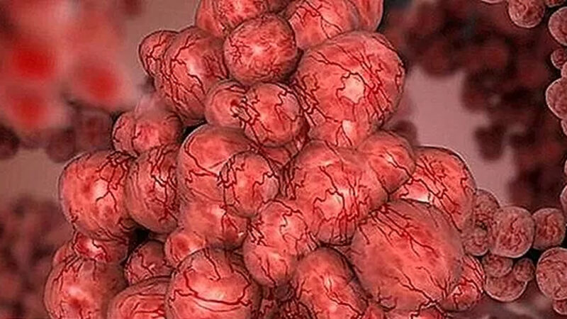 Cercetătorii au descoperit noi factori de risc, de natură genetică, pentru fibroza pulmonară idiopatică