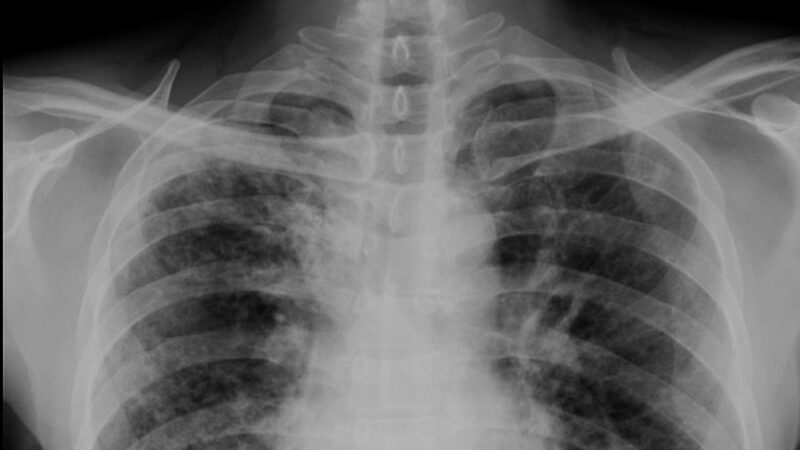 Ziua mondială de luptă împotriva pneumoniei: „Fiecare respirație contează”