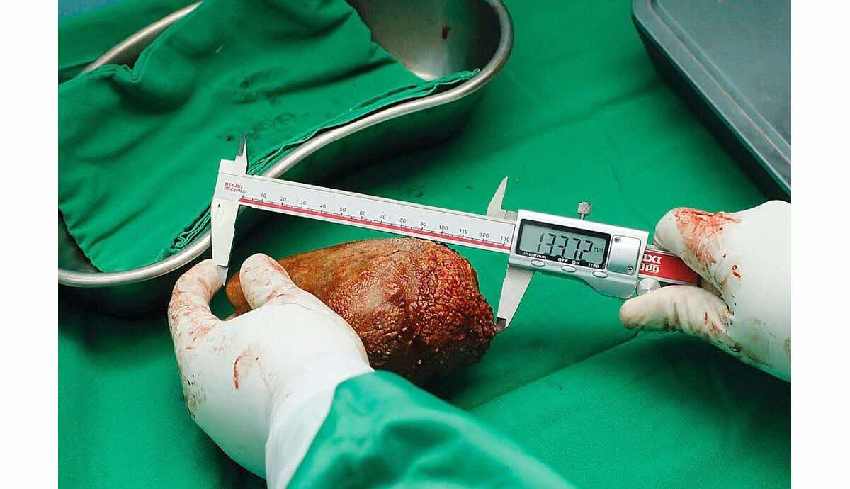 Cel mai mare calcul renal din lume a fost îndepărtat chirurgical de medici din Sri Lanka. Cântărea 801 grame