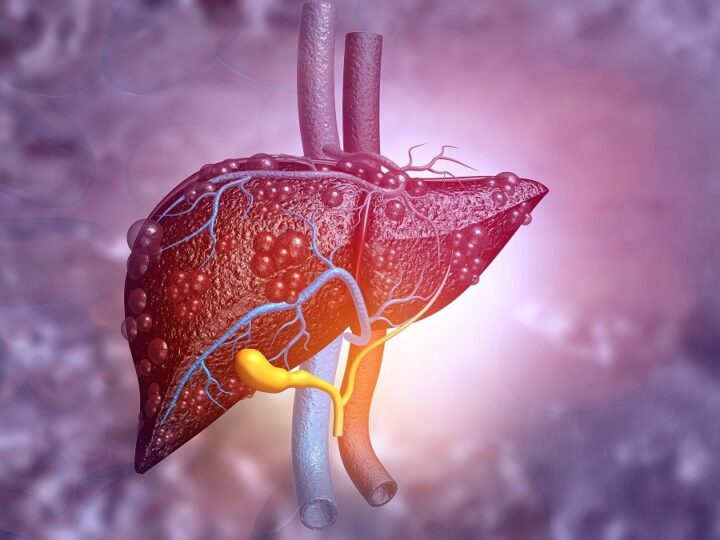 Cinci subtipuri de steatoză hepatică, identificate prin analiza datelor genetice și clinice