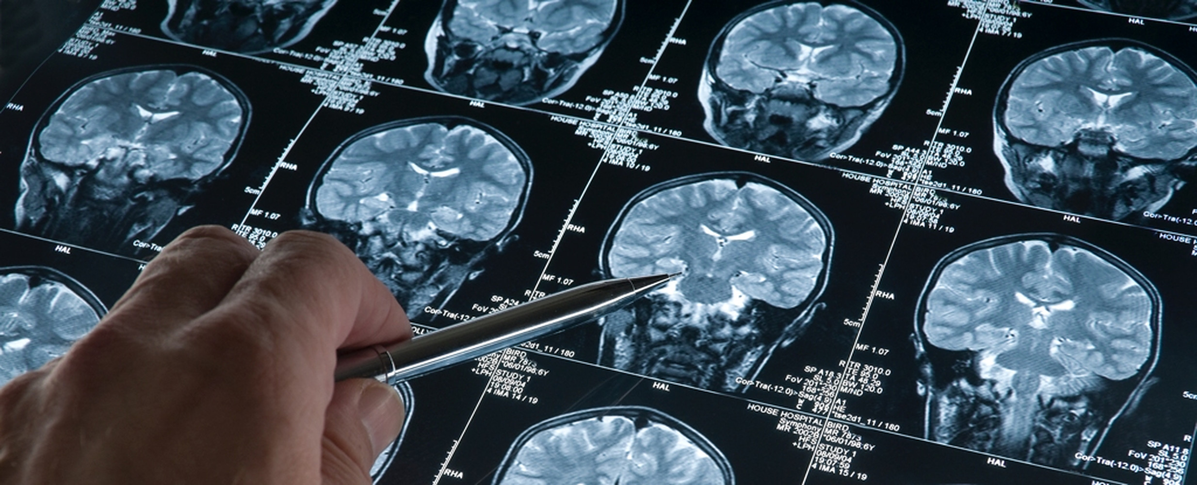 Medicii au descoperit un ac înfipt în creierul unei femei de 80 de ani