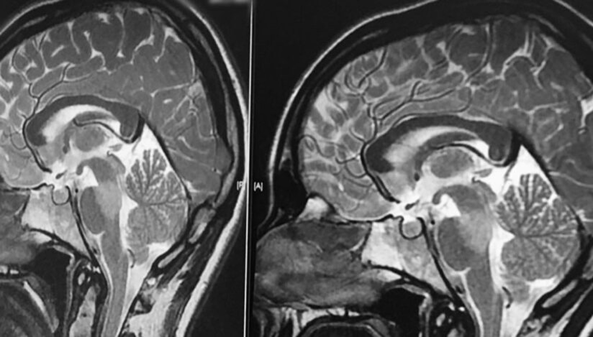 Tehnologie de vârf în imagistica cerebrală. RMN ultra-performant pentru studiul creierului copiilor